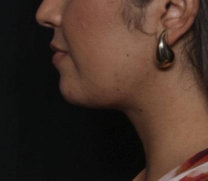 Liposuction Before & After Patient #36240