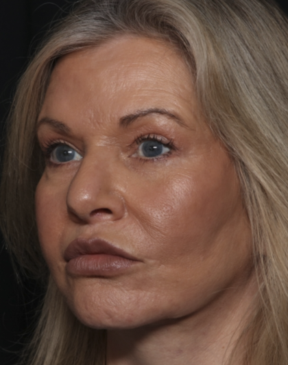 Injectable Fillers Before & After Patient #36213