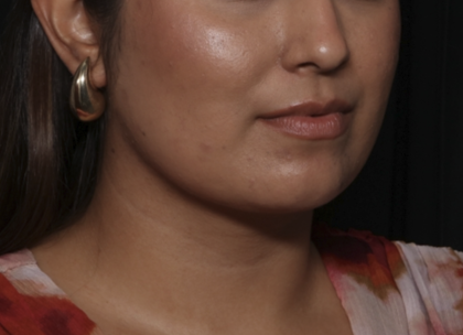 Liposuction Before & After Patient #36240