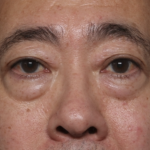 Blepharoplasty Before & After Patient #36225