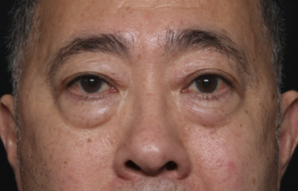Blepharoplasty Before & After Patient #36225