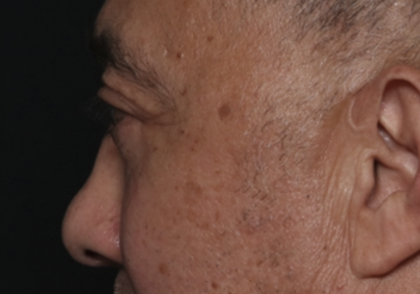 Blepharoplasty Before & After Patient #36225