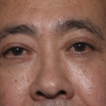 Blepharoplasty Before & After Patient #36225