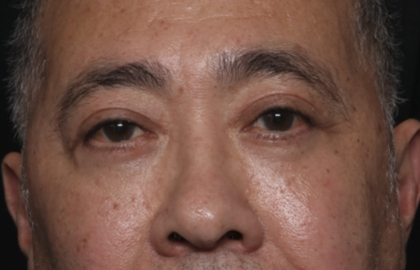 Blepharoplasty Before & After Patient #36225