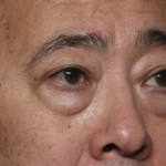 Blepharoplasty Before & After Patient #36225