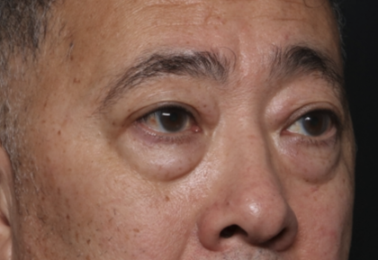Blepharoplasty Before & After Patient #36225