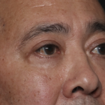 Blepharoplasty Before & After Patient #36225