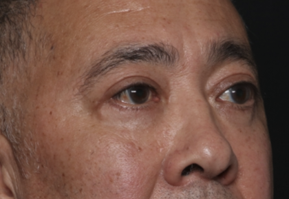 Blepharoplasty Before & After Patient #36225