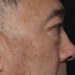 Blepharoplasty Before & After Patient #36225
