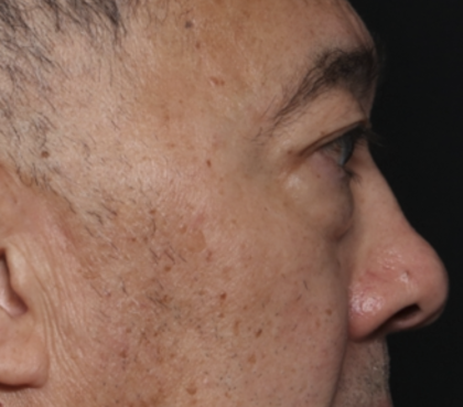 Blepharoplasty Before & After Patient #36225