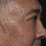 Blepharoplasty Before & After Patient #36225