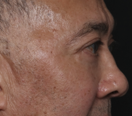 Blepharoplasty Before & After Patient #36225