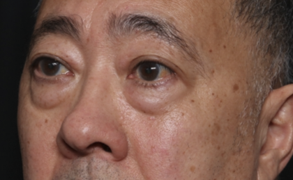 Blepharoplasty Before & After Patient #36225
