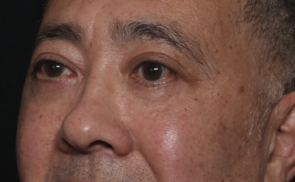 Blepharoplasty Before & After Patient #36225
