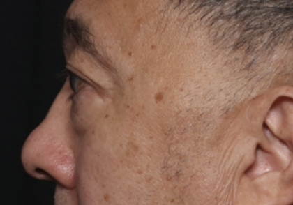 Blepharoplasty Before & After Patient #36225