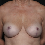 Breast Lift Before & After Patient #36262