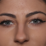 Rhinoplasty Before & After Patient #36273