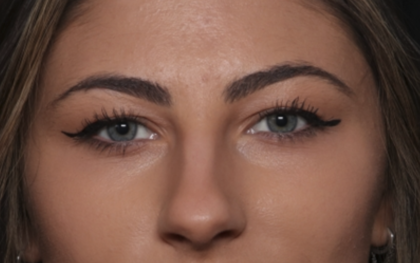Rhinoplasty Before & After Patient #36273