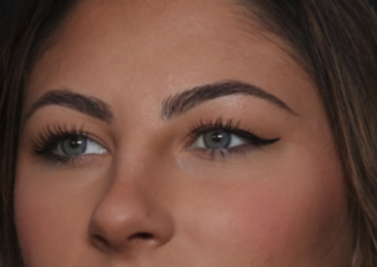 Rhinoplasty Before & After Patient #36273