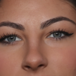 Rhinoplasty Before & After Patient #36273