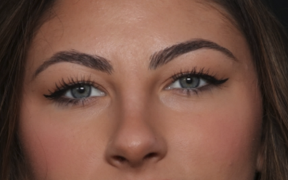 Rhinoplasty Before & After Patient #36273