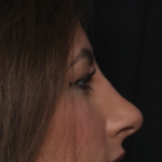 Rhinoplasty Before & After Patient #36273