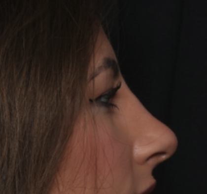 Rhinoplasty Before & After Patient #36273