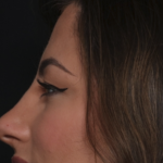Rhinoplasty Before & After Patient #36273