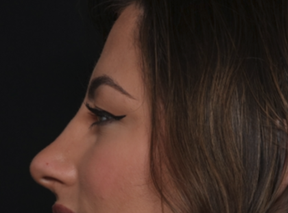 Rhinoplasty Before & After Patient #36273