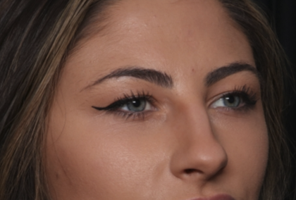 Rhinoplasty Before & After Patient #36273