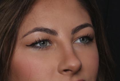 Rhinoplasty Before & After Patient #36273