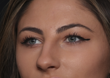 Rhinoplasty Before & After Patient #36273