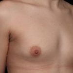 Breast Augmentation Before & After Patient #36362