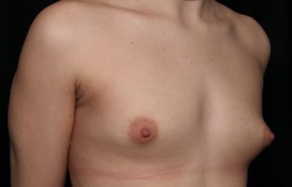 Breast Augmentation Before & After Patient #36362