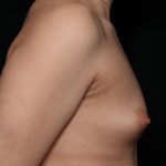 Breast Augmentation Before & After Patient #36362