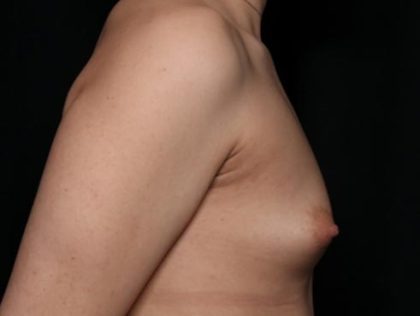 Breast Augmentation Before & After Patient #36362