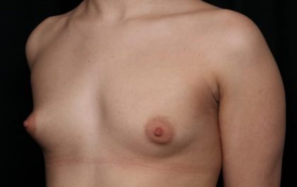 Breast Augmentation Before & After Patient #36362