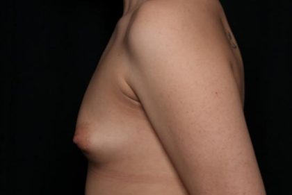 Breast Augmentation Before & After Patient #36362