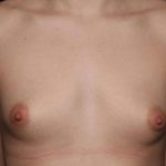 Breast Augmentation Before & After Patient #36362