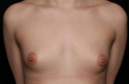 Breast Augmentation Before & After Patient #36362