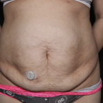 Tummy Tuck Before & After Patient #36340