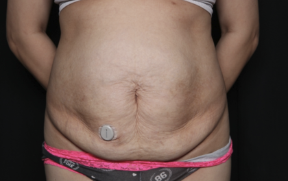 Tummy Tuck Before & After Patient #36340