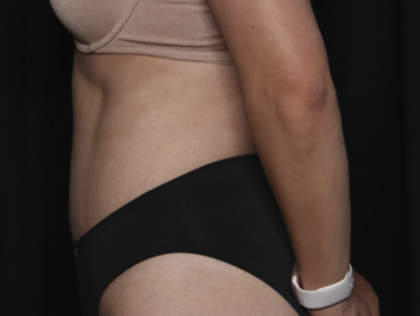 Tummy Tuck Before & After Patient #36340