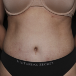 Tummy Tuck Before & After Patient #36340