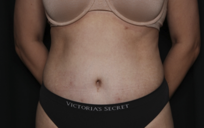 Tummy Tuck Before & After Patient #36340