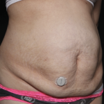 Tummy Tuck Before & After Patient #36340