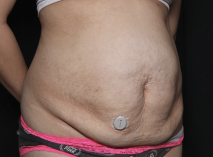 Tummy Tuck Before & After Patient #36340