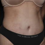 Tummy Tuck Before & After Patient #36340