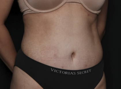 Tummy Tuck Before & After Patient #36340