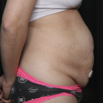 Tummy Tuck Before & After Patient #36340